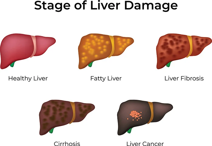 Picture of 5 human liver showing stages of liver damage